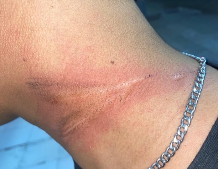 Luka lecet di leher pengendara akibat terlilit kabel wifi di Loloan Timur, Jembrana